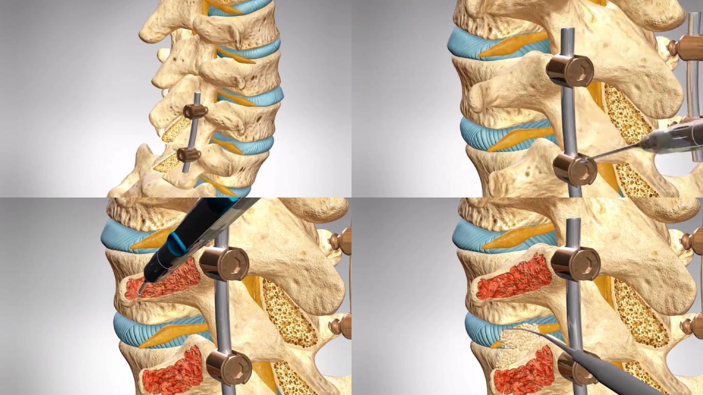 腰椎融合术腰椎融合手术演示动画