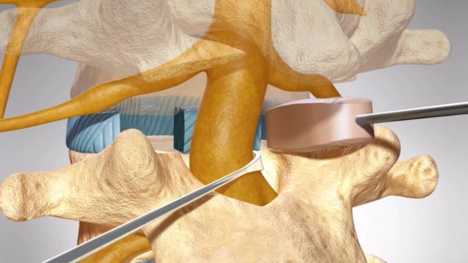 后路腰椎椎体间融合术腰椎间盘置换手术