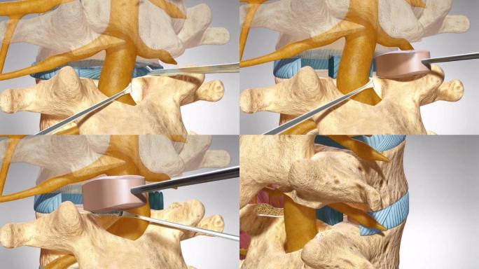 后路腰椎椎体间融合术腰椎间盘置换手术