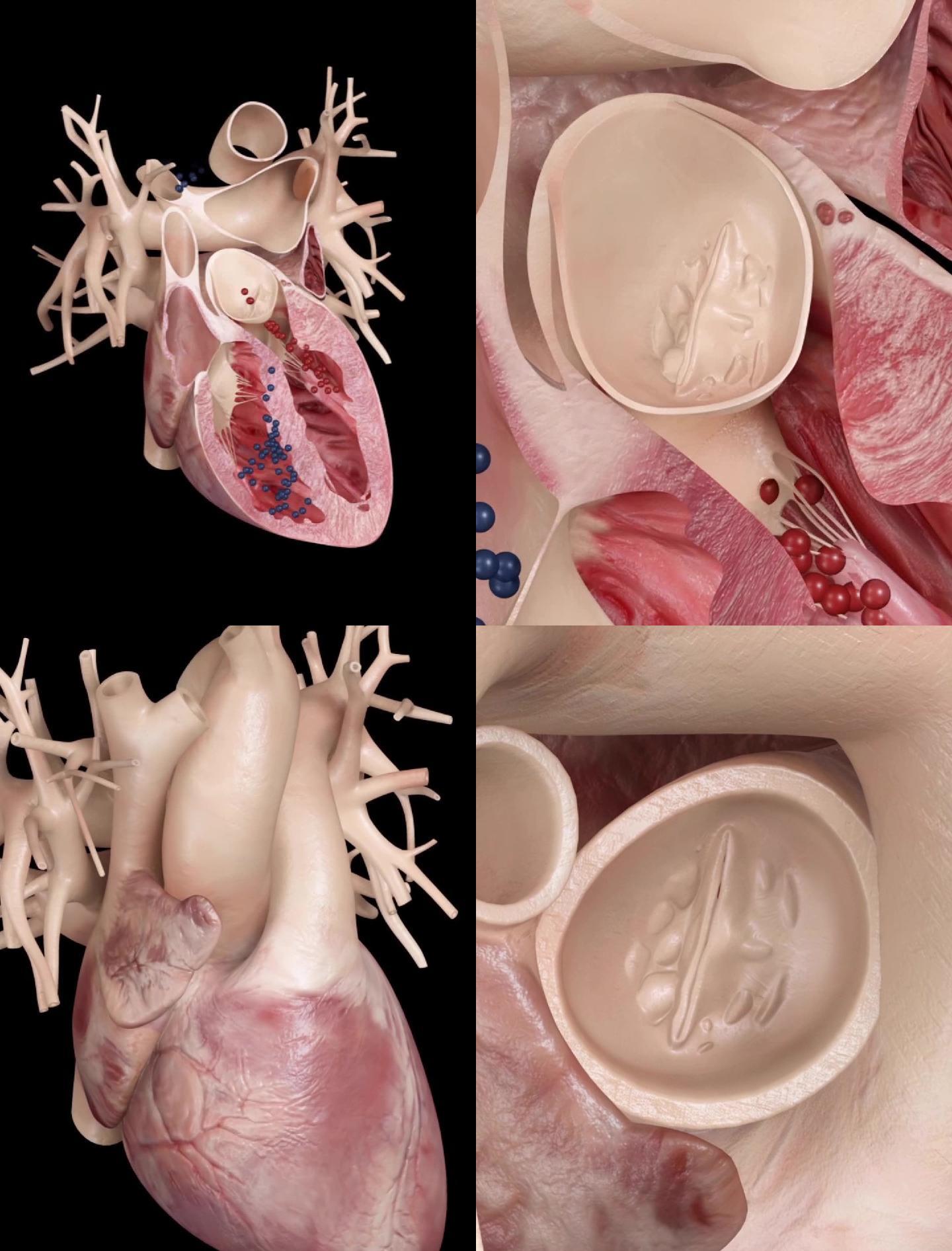 心脏病心脏疾病二尖瓣狭窄演示动画
