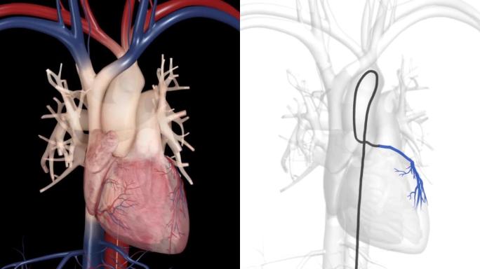 心脏疾病心脏静脉血管堵塞手术