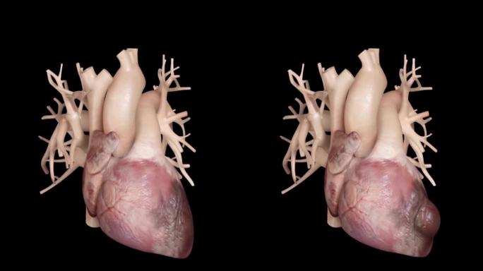 心脏疾病心脏病左心室增大动画演示