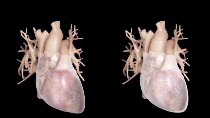 心脏疾病心肌梗死心包演示动画