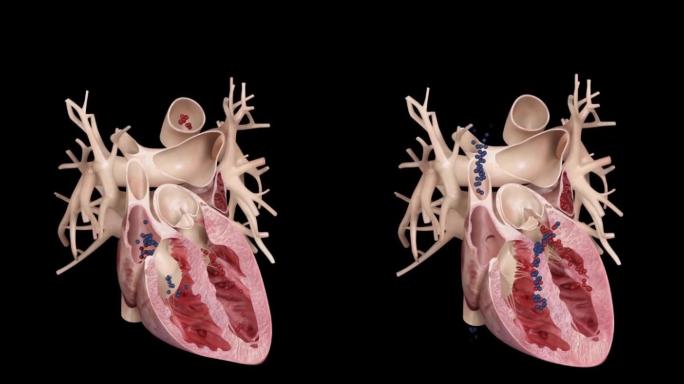 心脏血液循环心脏病演示动画
