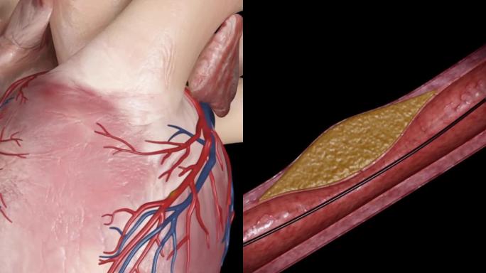 心脏动脉扩张演示动画