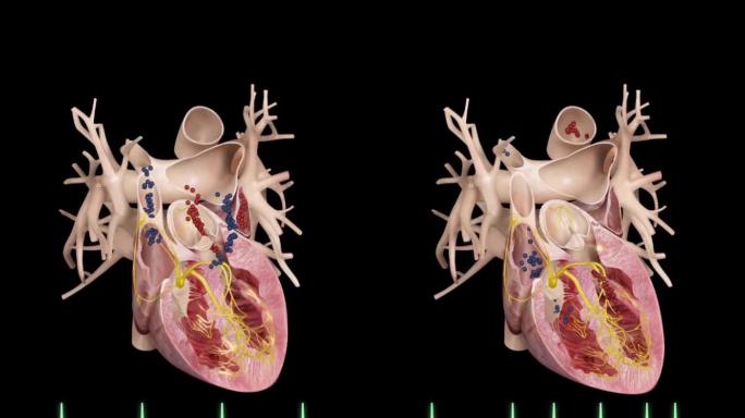 心脏病心脏疾病心脏工作原理心电图演示动画