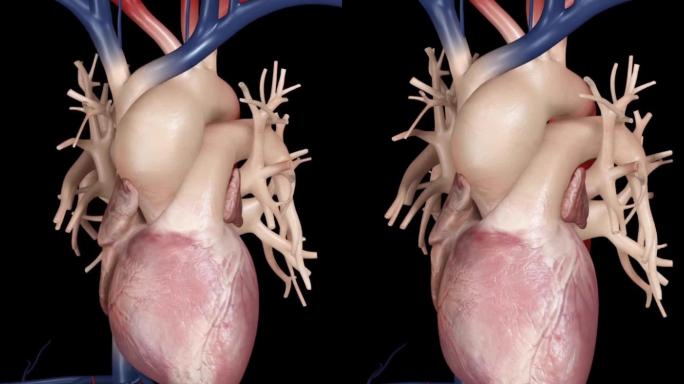 心脏疾病心脏血管壁增厚增大动画演示