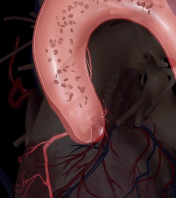 心脏疾病心脏血管壁增厚动画演示