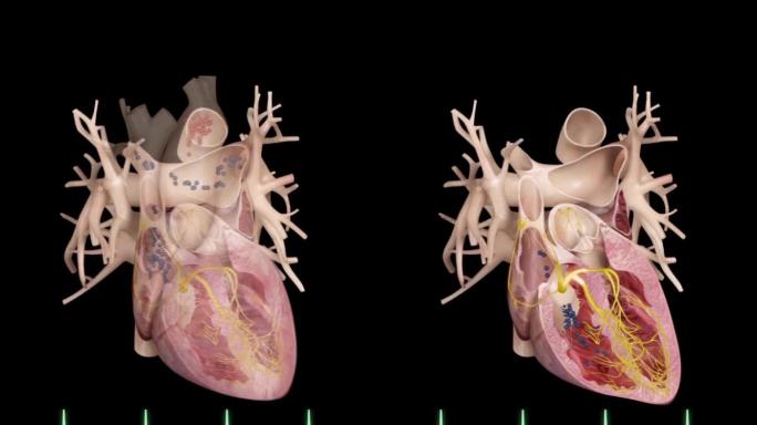 右心耳血栓抖动心脏疾病动画