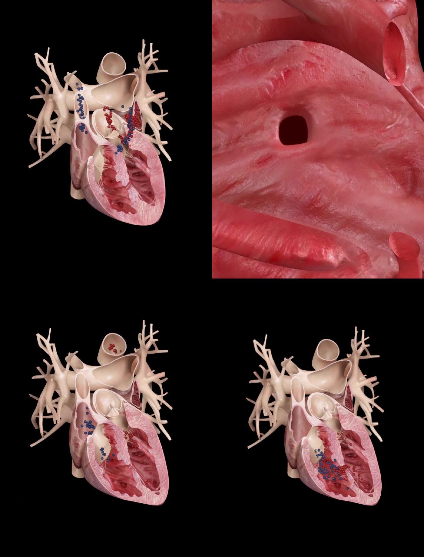 心脏左心室右心室穿孔动画演示