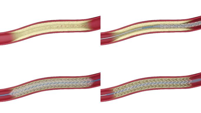 心脏支架安装