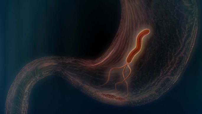幽门螺旋杆菌引起胃及十二指肠溃疡