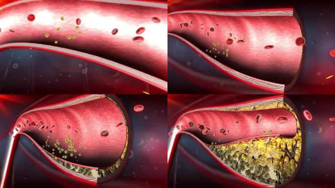 胆固醇沉积于动脉壁内皮细胞坏死露于血管腔