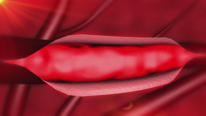 胶元纤维增生至管壁增厚血管管腔狭窄闭塞
