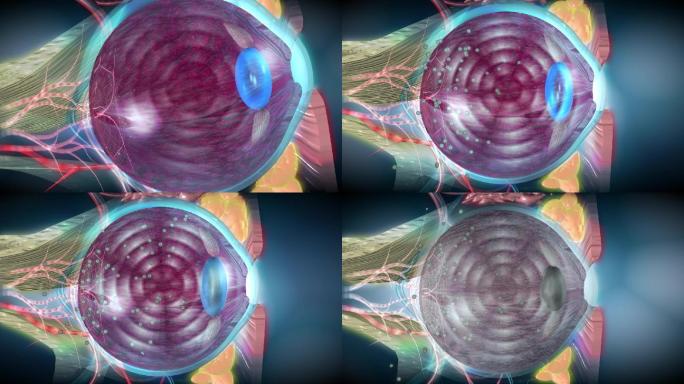 糖尿病引起的动脉硬化导致视力下降甚至失明
