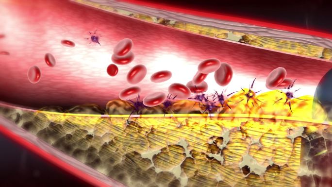 血小板红细胞胆固醇聚积导致动脉粥样硬化