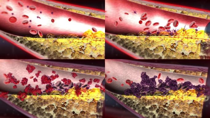 血小板红细胞胆固醇聚积导致动脉粥样硬化
