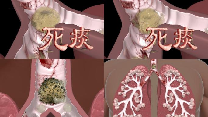 (带通道）肺病粘痰