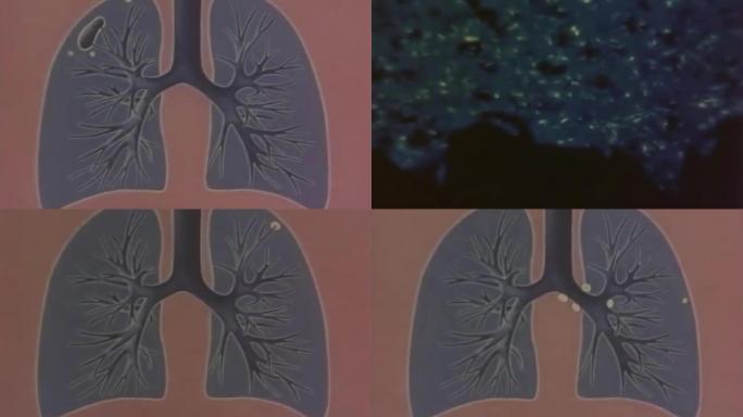 上世纪肺结核研究、肺部感染动画