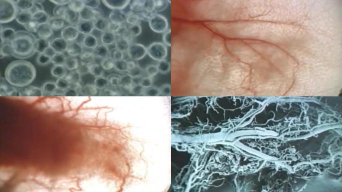 80年代癌症研究、肿瘤研究