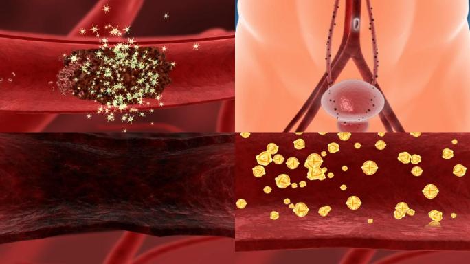 血管血栓垃圾