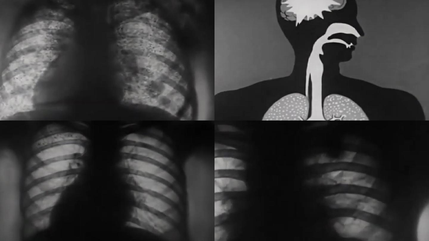 上世纪肺结核病人、肺部影像