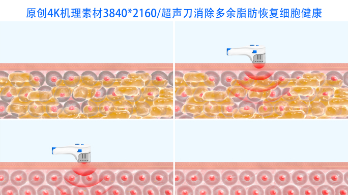 【4K】超声刀消除皮下脂肪