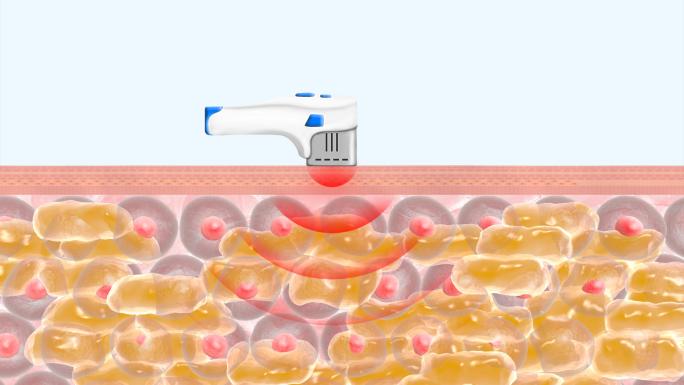 【4K】超声刀消除皮下脂肪