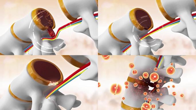 腰椎纤维环修复三维动画