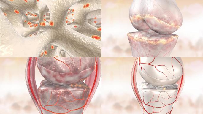 膝关节修复三维动画