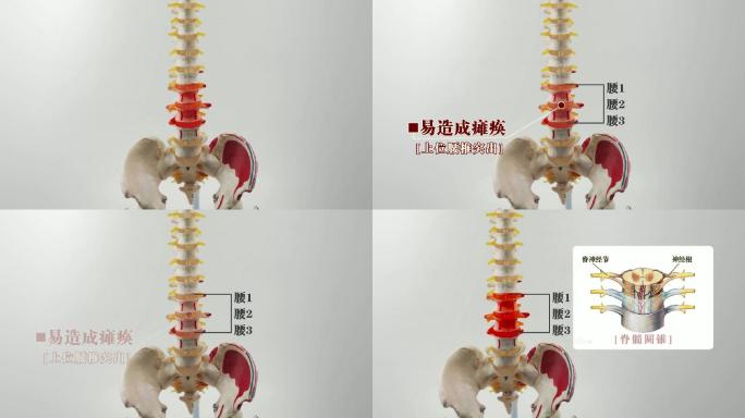 上位腰间盘突出易引发的疾病