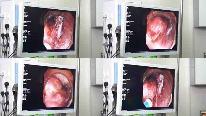 医疗内镜图像