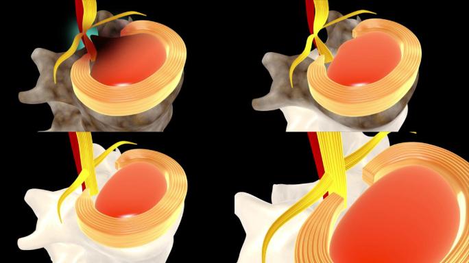腰突髓核纤维环腰椎病