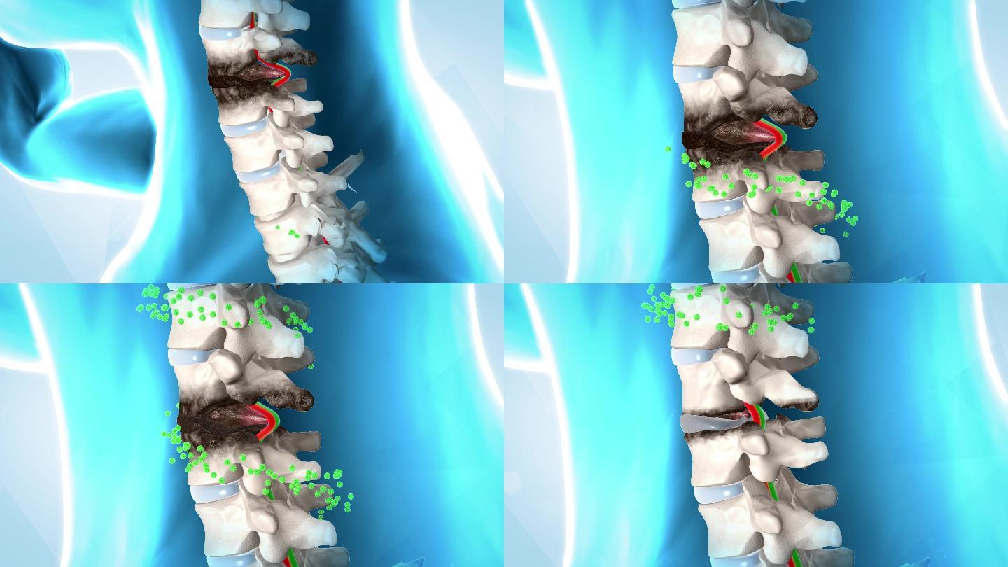颈椎病骨骼机理视频素材