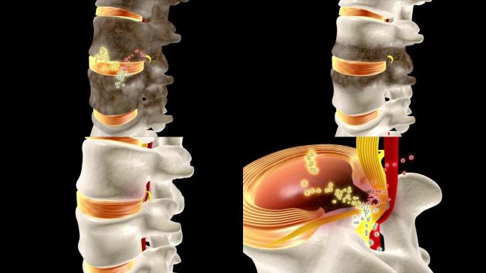 修复髓核纤维环视频素材