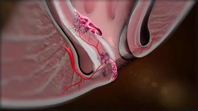 混合痔的三维解剖形态和位置