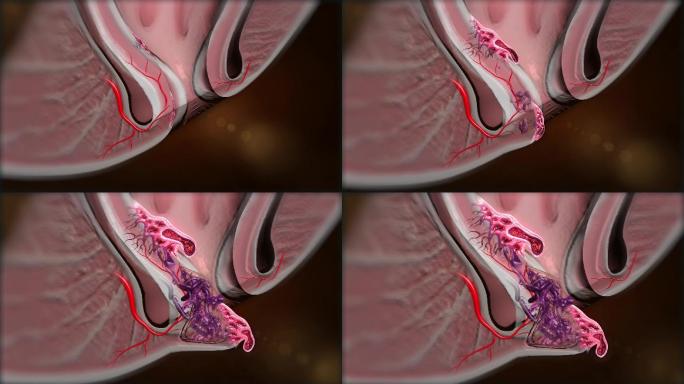 混合痔的三维解剖形态和位置