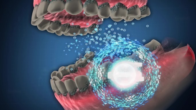 负电荷微粒清除牙菌斑及牙结石