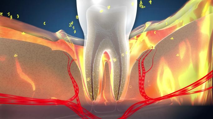 营养微粒补充牙龈退化营养使丰满包裹牙齿