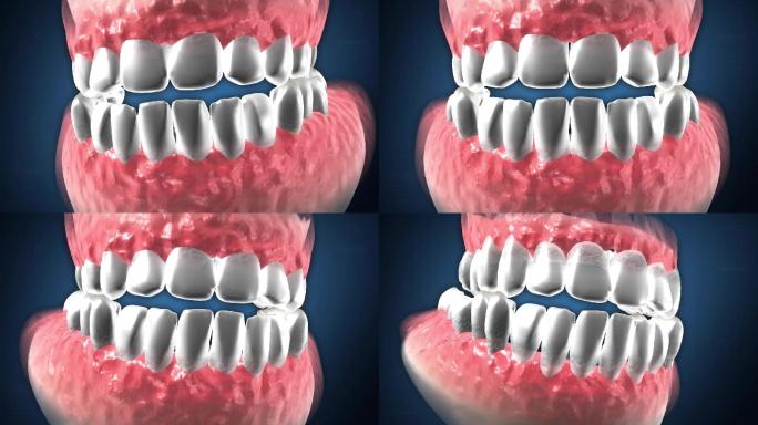 牙龈逐年萎缩最终导致牙根外露等一系列牙病