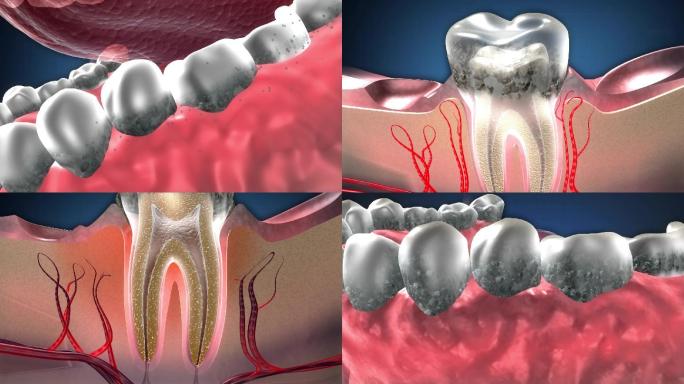 牙菌斑中细菌繁殖破坏牙齿，牙结石引起炎症