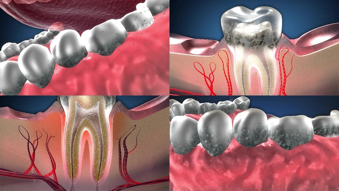 牙菌斑中细菌繁殖破坏牙齿，牙结石引起炎症