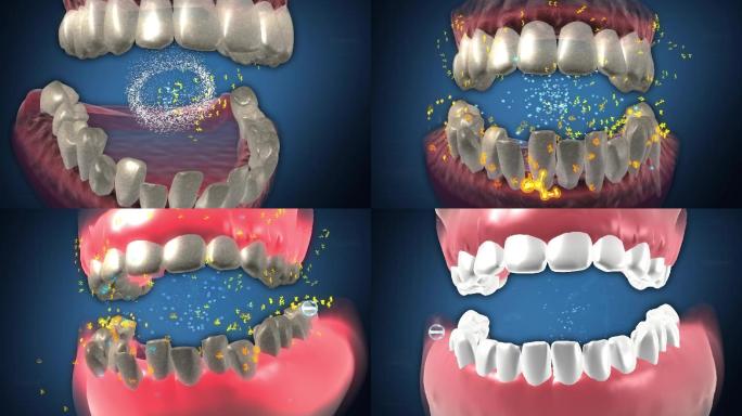 除菌斑脱牙石补充牙营养使萎缩的牙龈再生
