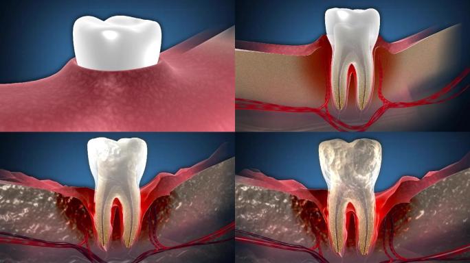 牙龈病变导致牙齿松动甚至脱落