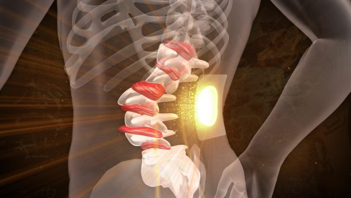 磁药膏贴在腰椎治疗椎间盘突出骨刺风湿增生