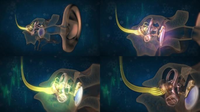 噪音等原因导致听神经受损萎缩坏死损伤听力