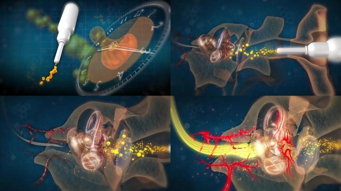 滴耳油能穿透血耳屏障修复听神经恢复听力