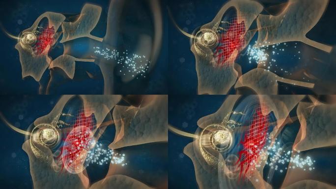 传统水性药不能突破血耳屏障无法修复听神经