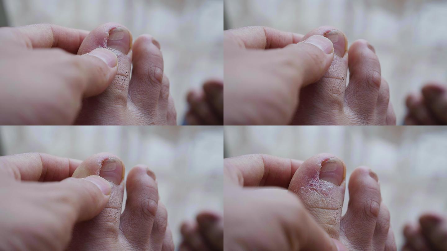 皮肤病-脚指皮肤病4k