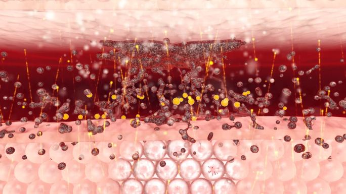 艾灸层层排出淤血细胞病毒自由基毒素